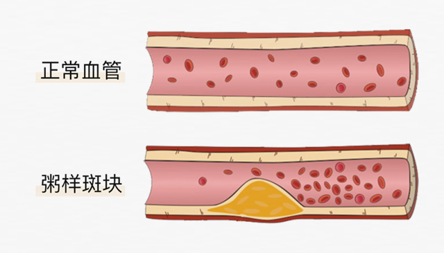血栓是心梗、腦梗的元兇，很容易找上這些人