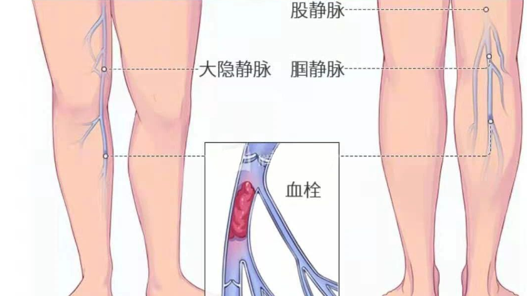 深靜脈血栓類似病癥的認識與區(qū)分