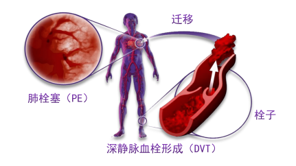 骨科術(shù)后重點關(guān)注的問題—VTE，該如何防治？