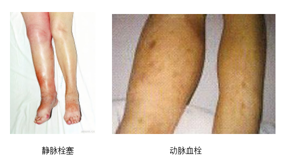 動(dòng)脈血栓和靜脈血栓有什么區(qū)別嗎？