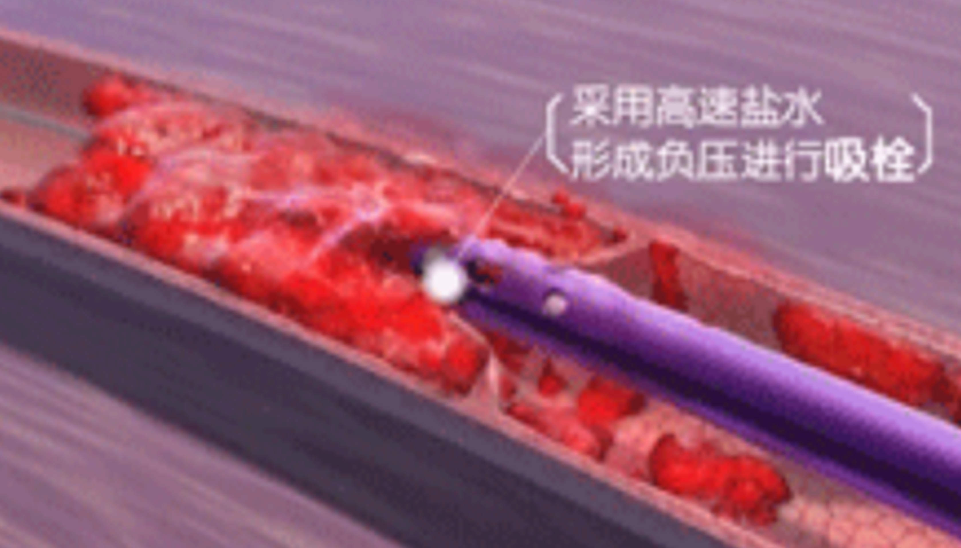 深靜脈血栓能致命，防治“大法”要了解！