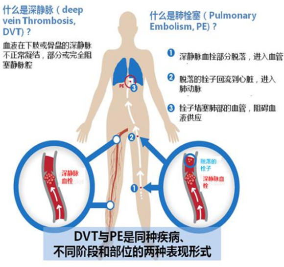 腫瘤患者VTE的預防