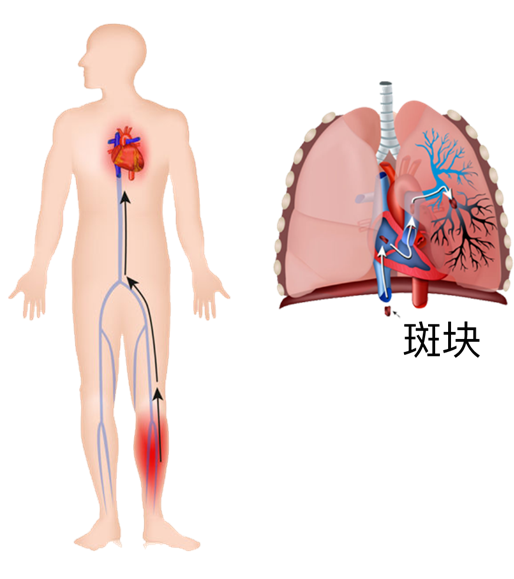 血栓是心梗、腦梗的元兇，很容易找上這些人
