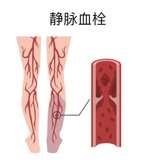 血栓是心梗、腦梗的元兇，很容易找上這些人