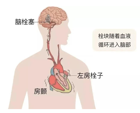 血栓是心梗、腦梗的元兇，很容易找上這些人