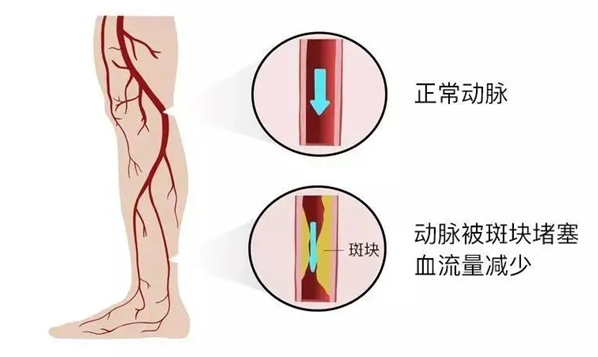 血栓是心梗、腦梗的元兇，很容易找上這些人