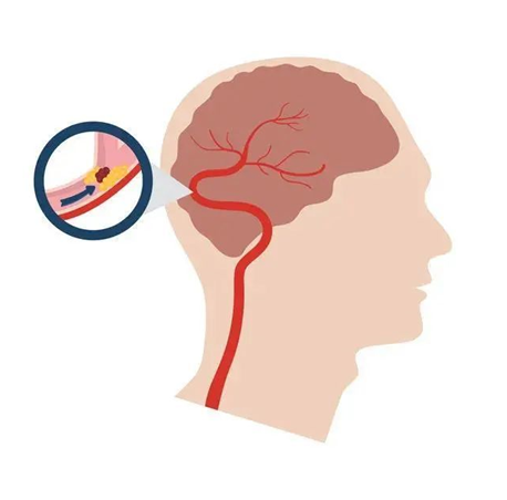 血栓是心梗、腦梗的元兇，很容易找上這些人