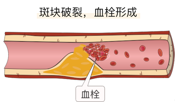 血栓是心梗、腦梗的元兇，很容易找上這些人
