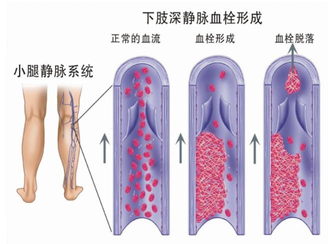 警惕！這個(gè)全球“第三大心血管殺手”，我們?cè)撊绾螒?yīng)對(duì)？