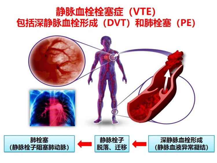 世界血栓日 | 拴不住，動起來