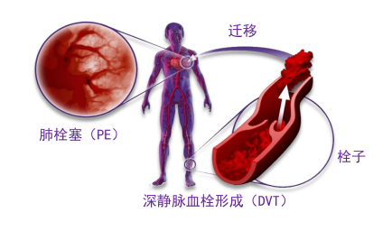 骨科術(shù)后重點(diǎn)關(guān)注的問(wèn)題—VTE，該如何防治？
