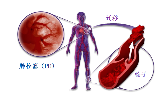 動(dòng)脈血栓和靜脈血栓有什么區(qū)別嗎？