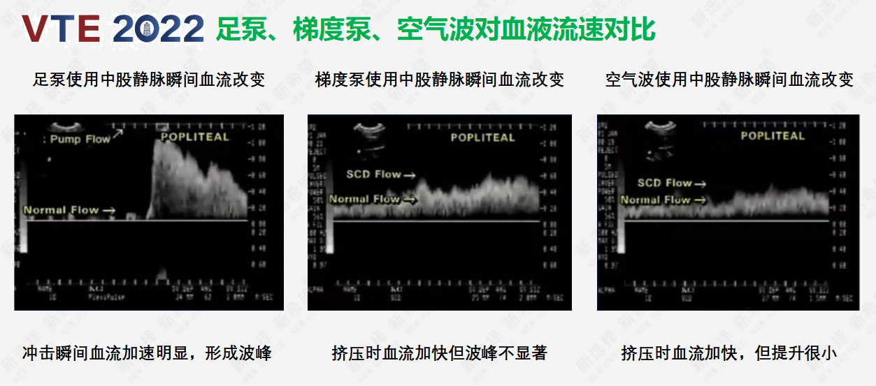 圍術期患者VTE的預防，只知道抗凝可不行