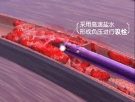 深靜脈血栓能致命，防治“大法”要了解！