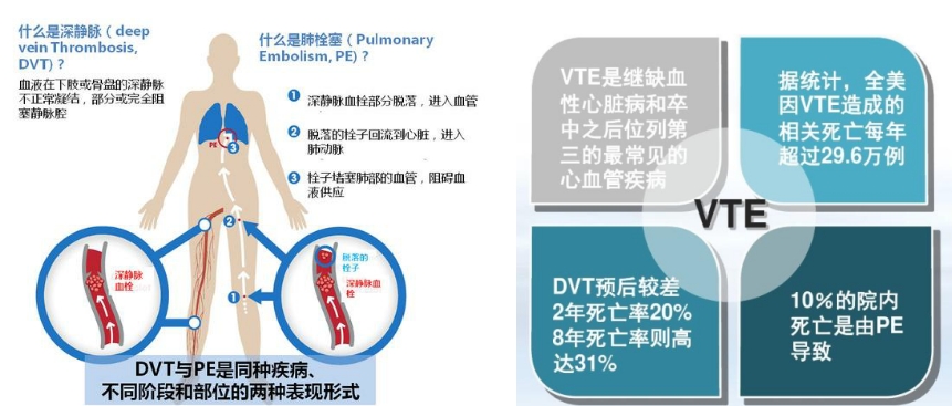 VTE的危害您了解嗎？