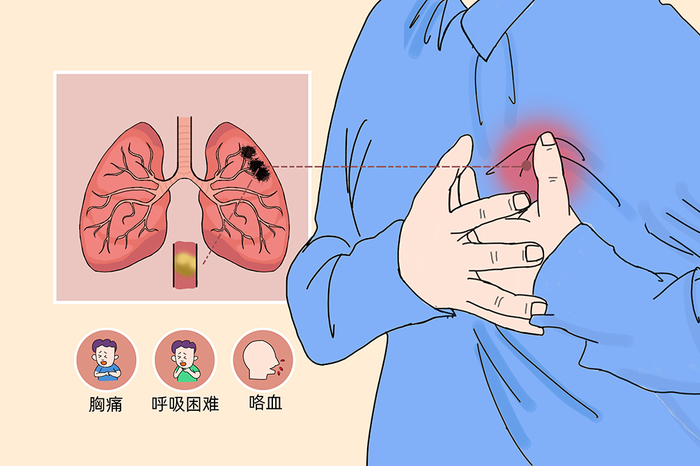 VTE的危害您了解嗎？