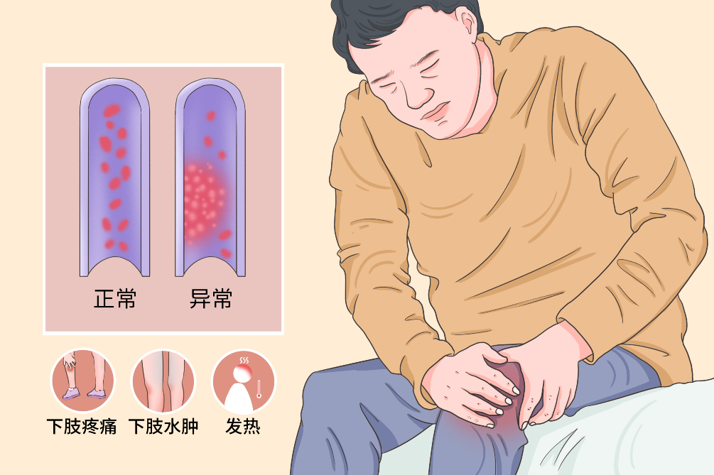 VTE的危害您了解嗎？