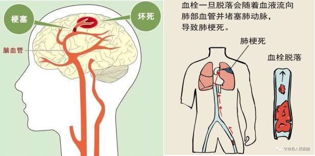 腦梗與深靜脈血栓：不可忽視的血管危機