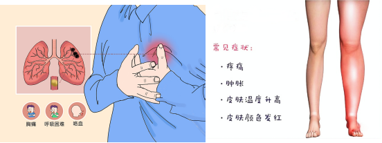 腦梗與深靜脈血栓：不可忽視的血管危機